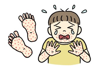 手足口病の隔離中にすべきこと